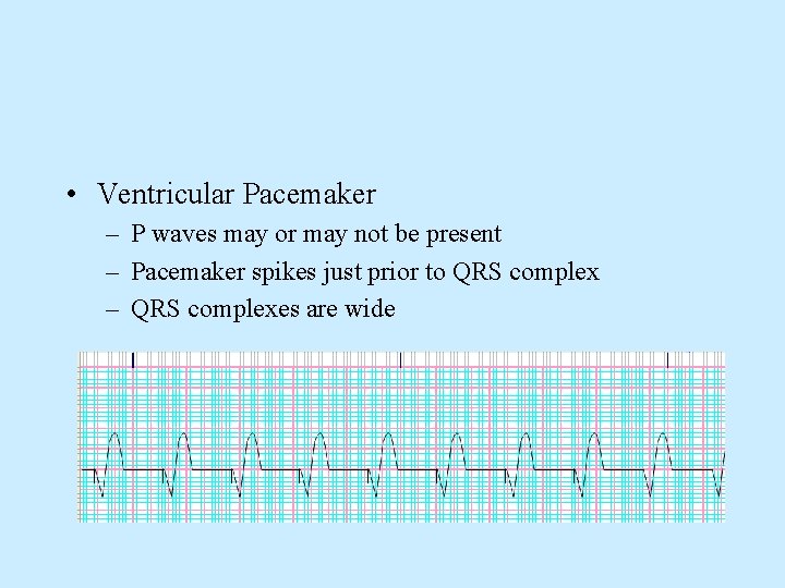  • Ventricular Pacemaker – P waves may or may not be present –