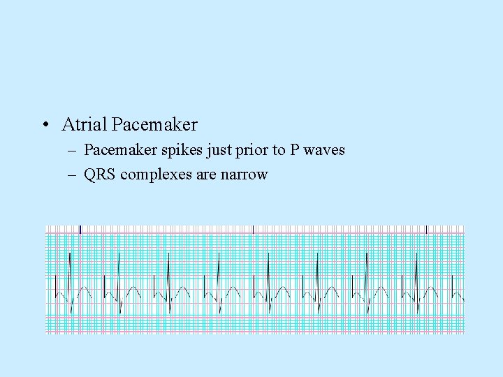  • Atrial Pacemaker – Pacemaker spikes just prior to P waves – QRS