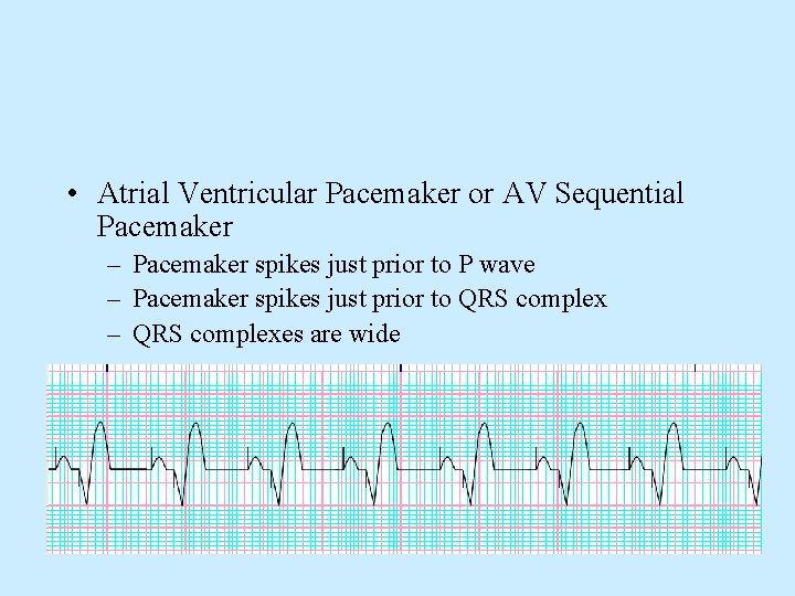  • Atrial Ventricular Pacemaker or AV Sequential Pacemaker – Pacemaker spikes just prior