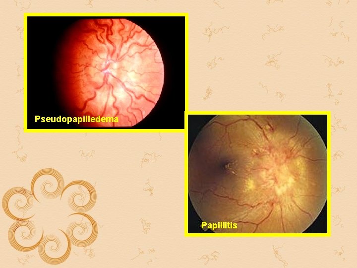 Pseudopapilledema Papillitis Pseudopapilledema Papillitis