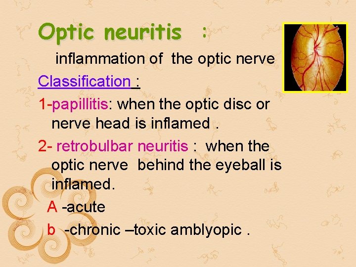 Optic neuritis : inflammation of the optic nerve Classification : 1 -papillitis: when the Optic neuritis : inflammation of the optic nerve Classification : 1 -papillitis: when the