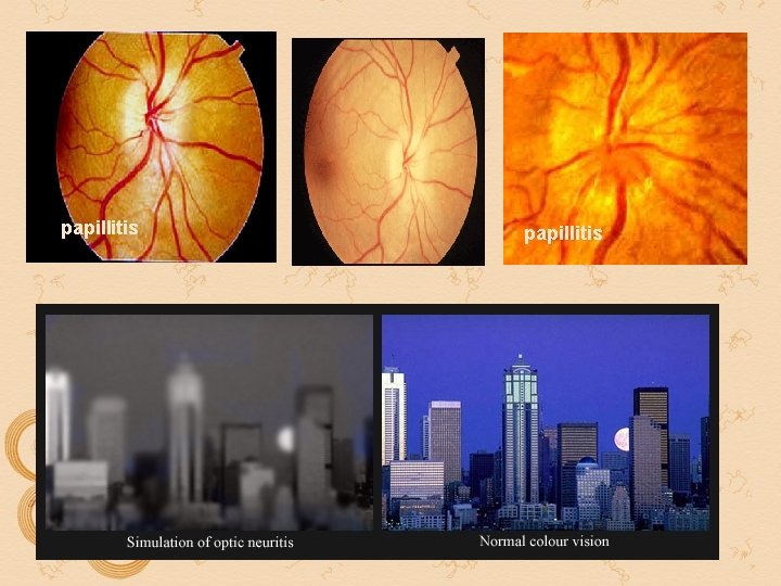 papillitis papillitis