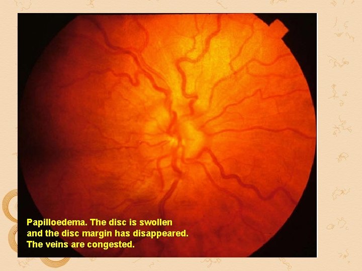 Papilloedema. The disc is swollen and the disc margin has disappeared. The veins are Papilloedema. The disc is swollen and the disc margin has disappeared. The veins are