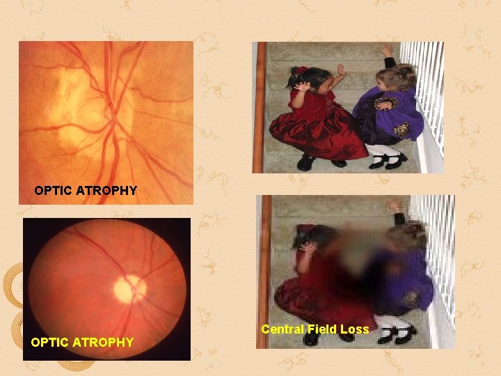 OPTIC ATROPHY Central Field Loss OPTIC ATROPHY Central Field Loss