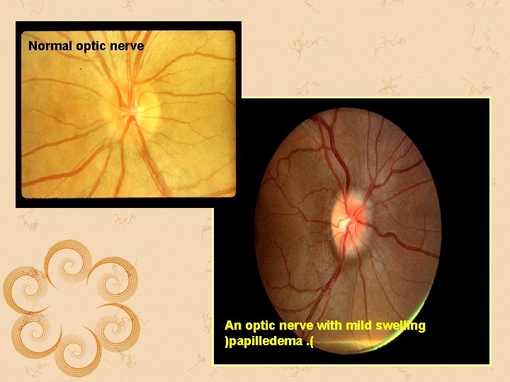 Normal optic nerve An optic nerve with mild swelling )papilledema. ( Normal optic nerve An optic nerve with mild swelling )papilledema. (