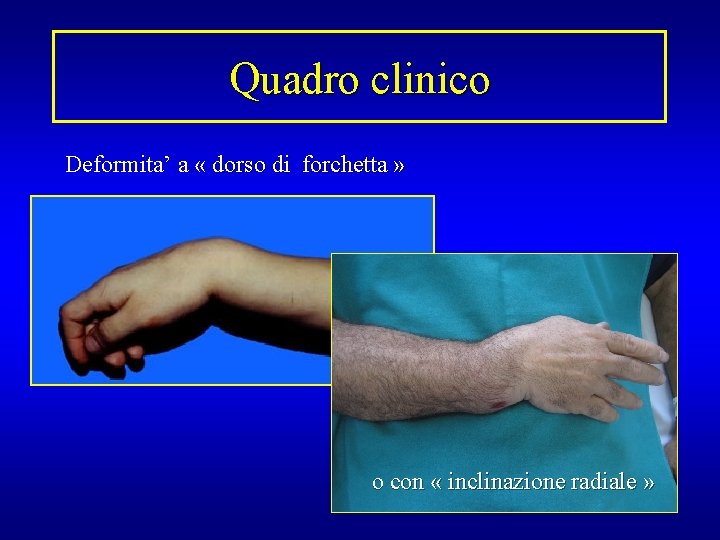 Quadro clinico Deformita’ a « dorso di forchetta » o con « inclinazione radiale