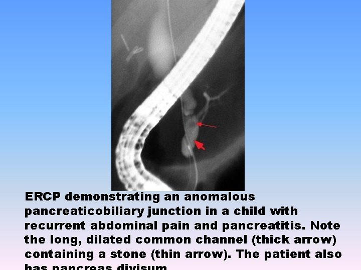 ERCP demonstrating an anomalous pancreaticobiliary junction in a child with recurrent abdominal pain and