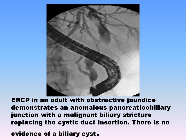 ERCP in an adult with obstructive jaundice demonstrates an anomalous pancreaticobiliary junction with a