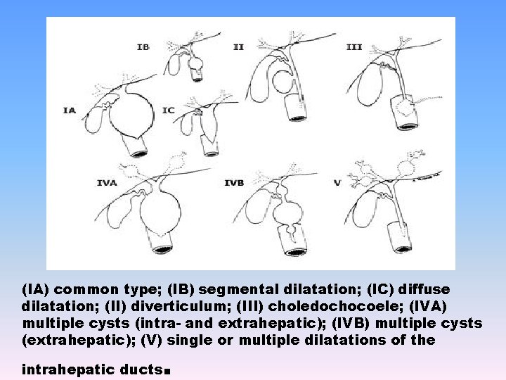 (IA) common type; (IB) segmental dilatation; (IC) diffuse dilatation; (II) diverticulum; (III) choledochocoele; (IVA)