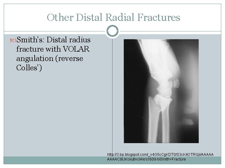 Other Distal Radial Fractures Smith’s: Distal radius fracture with VOLAR angulation (reverse Colles’) http: