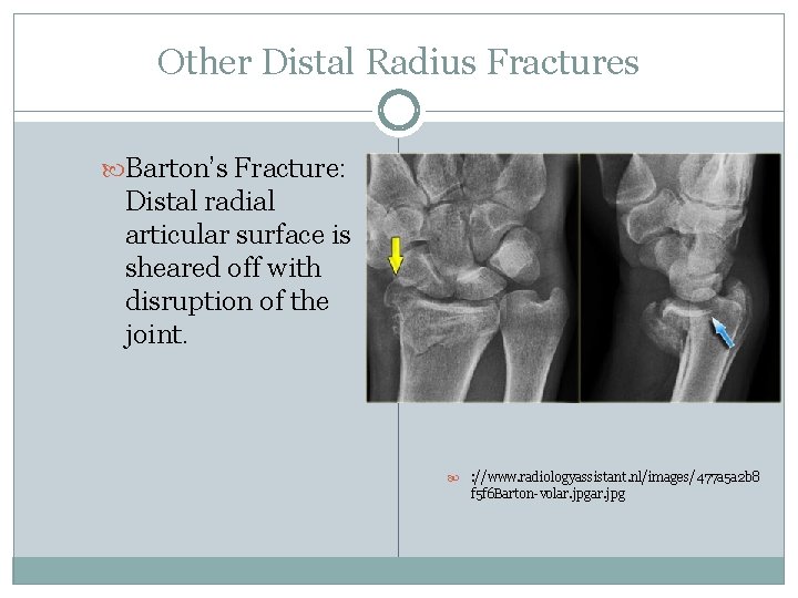Other Distal Radius Fractures Barton’s Fracture: Distal radial articular surface is sheared off with
