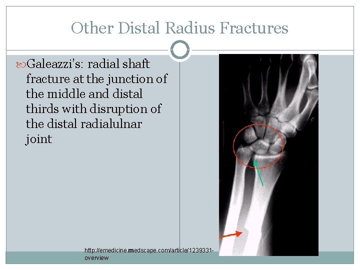Other Distal Radius Fractures Galeazzi’s: radial shaft fracture at the junction of the middle