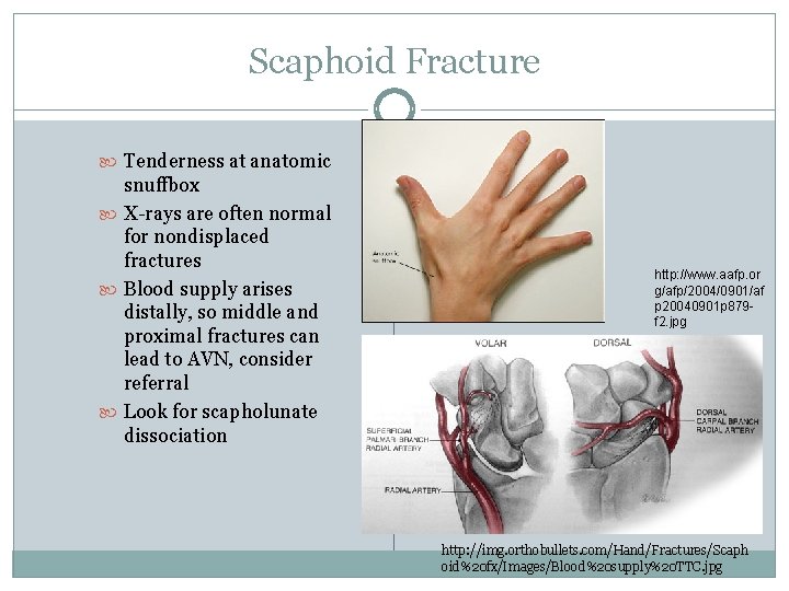 Scaphoid Fracture Tenderness at anatomic snuffbox X-rays are often normal for nondisplaced fractures Blood
