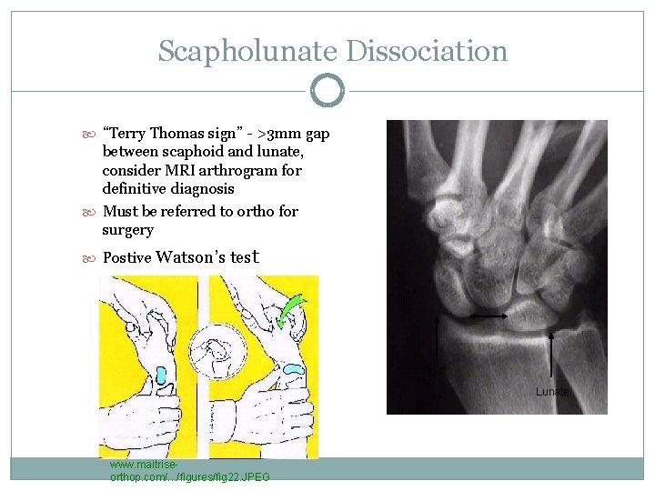 Scapholunate Dissociation “Terry Thomas sign” - >3 mm gap between scaphoid and lunate, consider