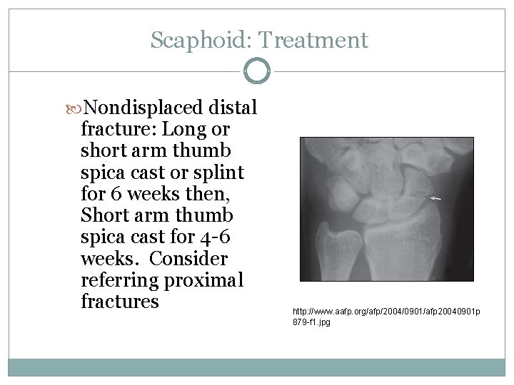 Scaphoid: Treatment Nondisplaced distal fracture: Long or short arm thumb spica cast or splint
