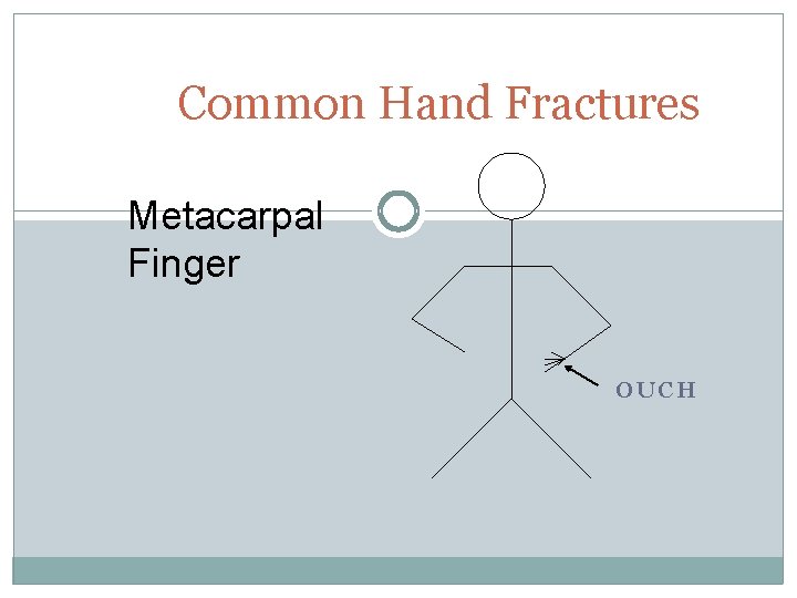 Common Hand Fractures Metacarpal Finger OUCH 
