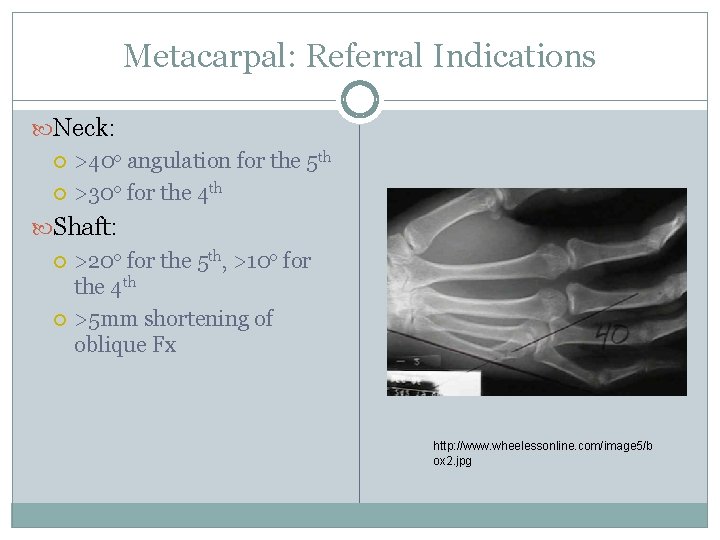 Metacarpal: Referral Indications Neck: >40 o angulation for the 5 th >30 o for