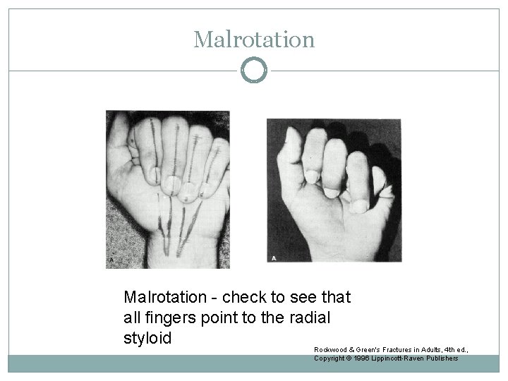 Malrotation - check to see that all fingers point to the radial styloid Rockwood