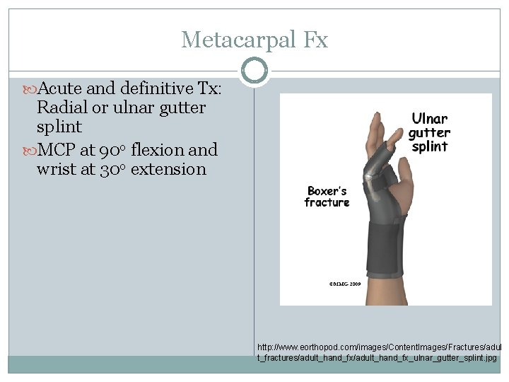 Metacarpal Fx Acute and definitive Tx: Radial or ulnar gutter splint MCP at 90