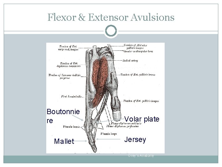 Flexor & Extensor Avulsions Boutonnie re Mallet Volar plate Jersey Grey’s Anatomy 