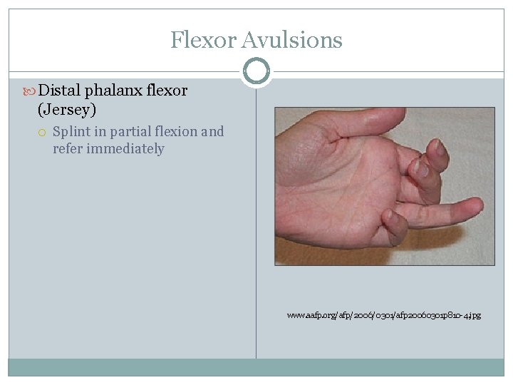 Flexor Avulsions Distal phalanx flexor (Jersey) Splint in partial flexion and refer immediately www.