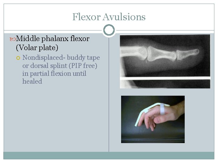 Flexor Avulsions Middle phalanx flexor (Volar plate) Nondisplaced- buddy tape or dorsal splint (PIP