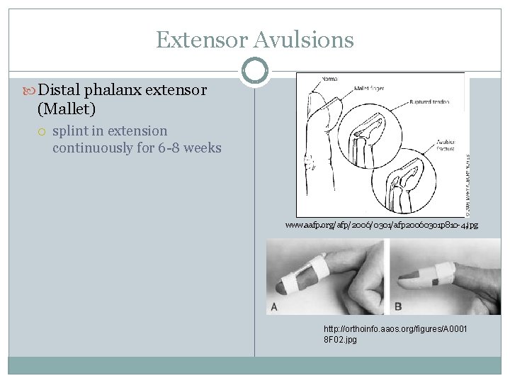 Extensor Avulsions Distal phalanx extensor (Mallet) splint in extension continuously for 6 -8 weeks