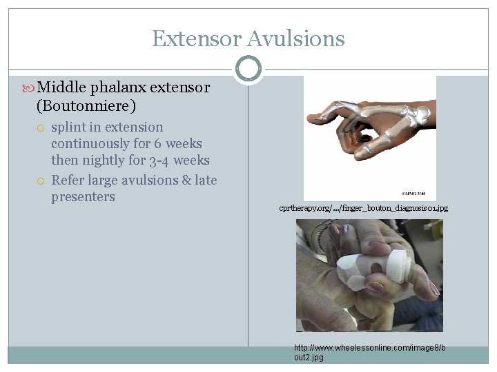 Extensor Avulsions Middle phalanx extensor (Boutonniere) splint in extension continuously for 6 weeks then