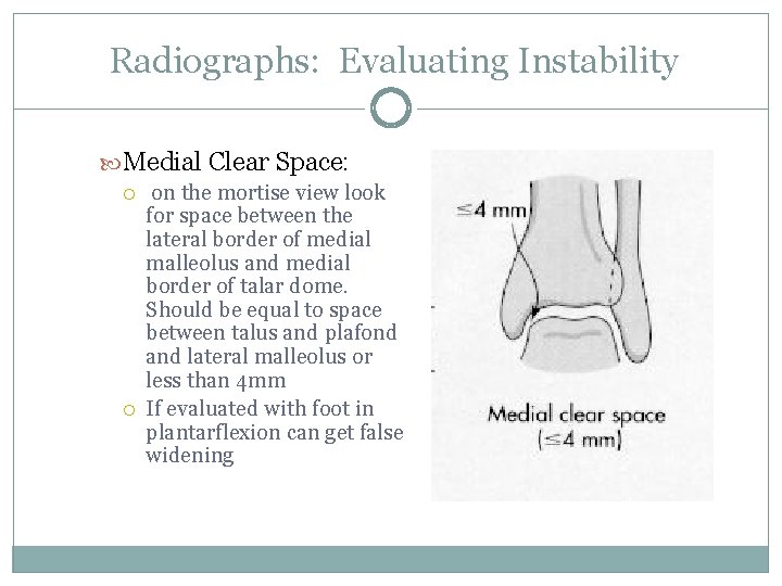 Radiographs: Evaluating Instability Medial Clear Space: on the mortise view look for space between