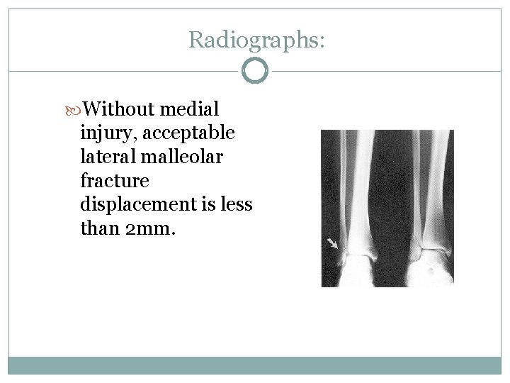 Radiographs: Without medial injury, acceptable lateral malleolar fracture displacement is less than 2 mm.