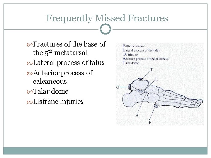 Frequently Missed Fractures of the base of the 5 th metatarsal Lateral process of