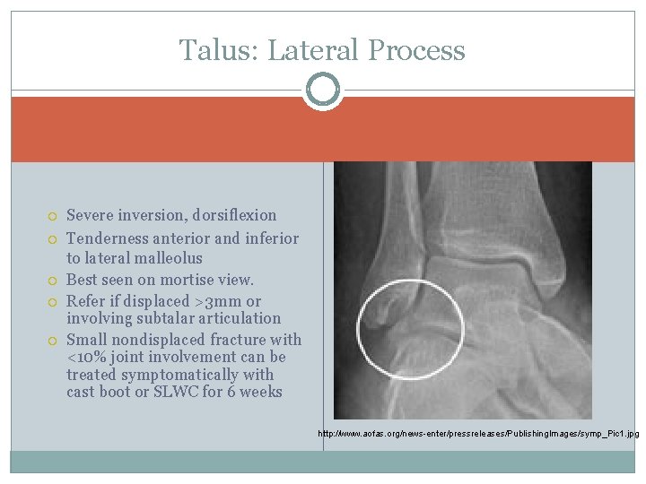 Talus: Lateral Process Severe inversion, dorsiflexion Tenderness anterior and inferior to lateral malleolus Best