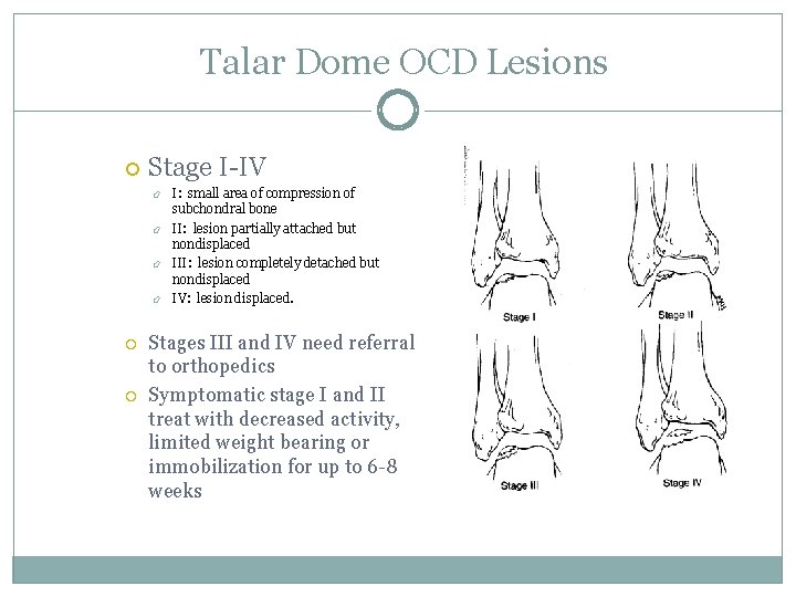 Talar Dome OCD Lesions Stage I-IV I: small area of compression of subchondral bone