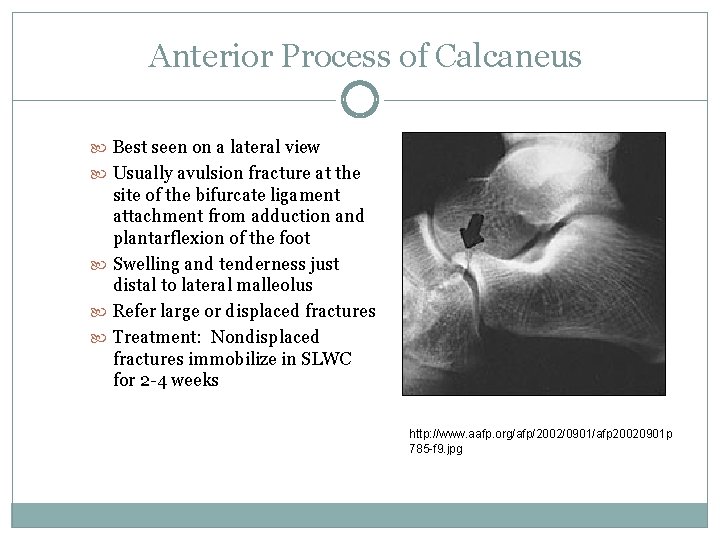 Anterior Process of Calcaneus Best seen on a lateral view Usually avulsion fracture at