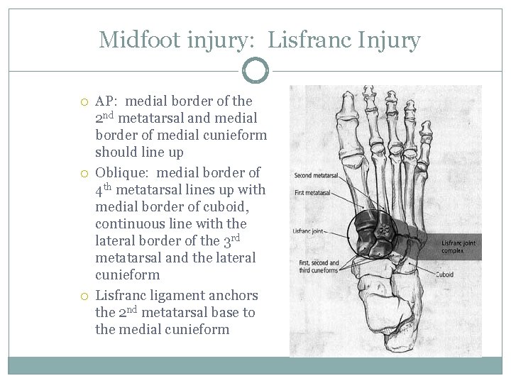 Midfoot injury: Lisfranc Injury AP: medial border of the 2 nd metatarsal and medial