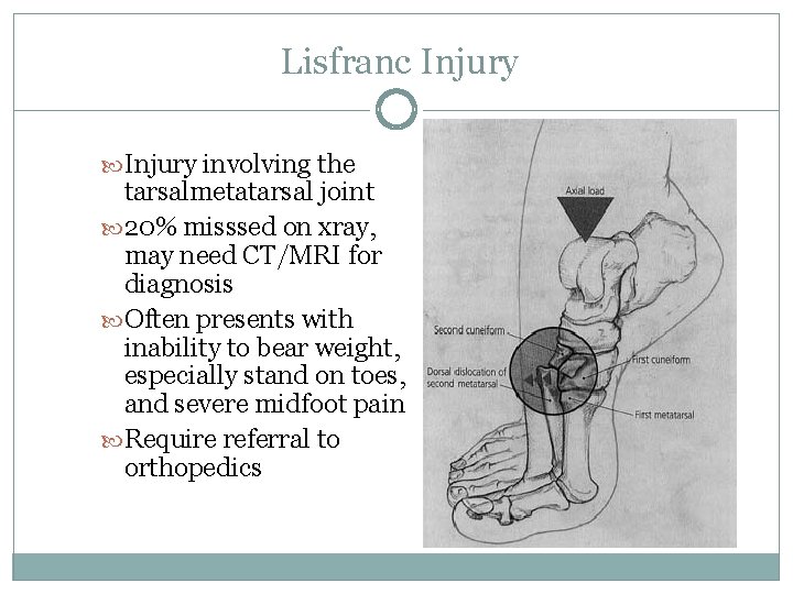 Lisfranc Injury involving the tarsalmetatarsal joint 20% misssed on xray, may need CT/MRI for