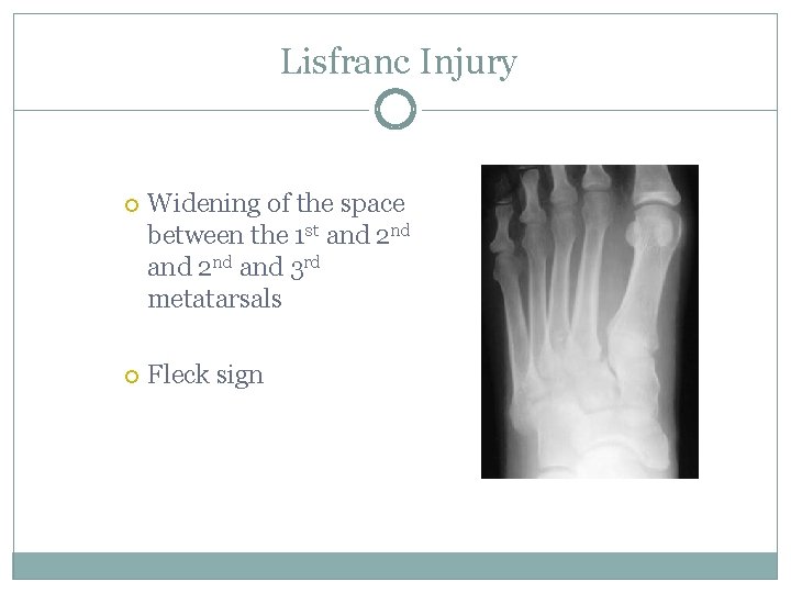 Lisfranc Injury Widening of the space between the 1 st and 2 nd and