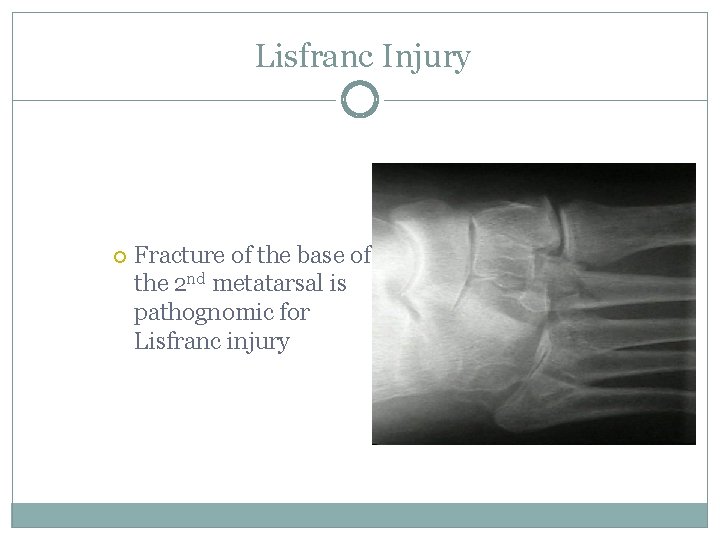 Lisfranc Injury Fracture of the base of the 2 nd metatarsal is pathognomic for