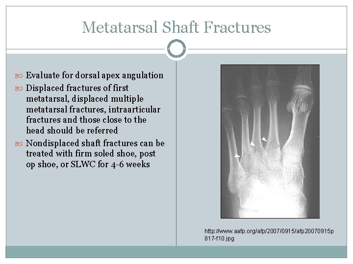 Metatarsal Shaft Fractures Evaluate for dorsal apex angulation Displaced fractures of first metatarsal, displaced