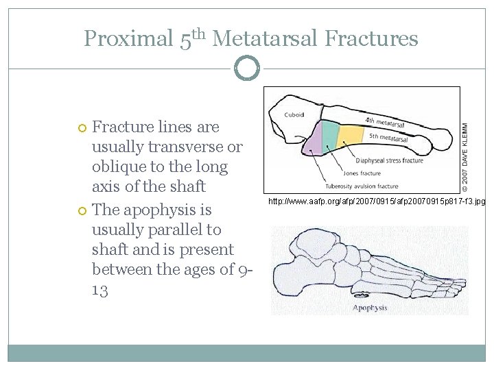 Proximal 5 th Metatarsal Fractures Fracture lines are usually transverse or oblique to the