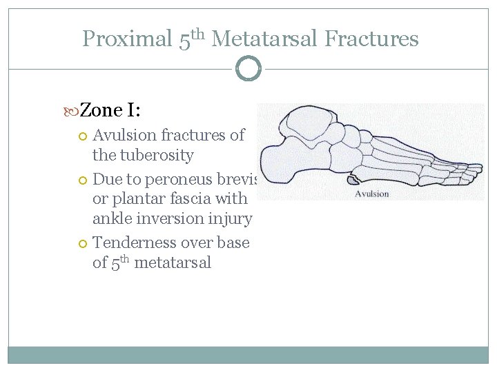 Proximal 5 th Metatarsal Fractures Zone I: Avulsion fractures of the tuberosity Due to