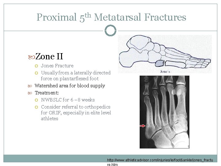 Proximal 5 th Metatarsal Fractures Zone II Jones Fracture Usually from a laterally directed
