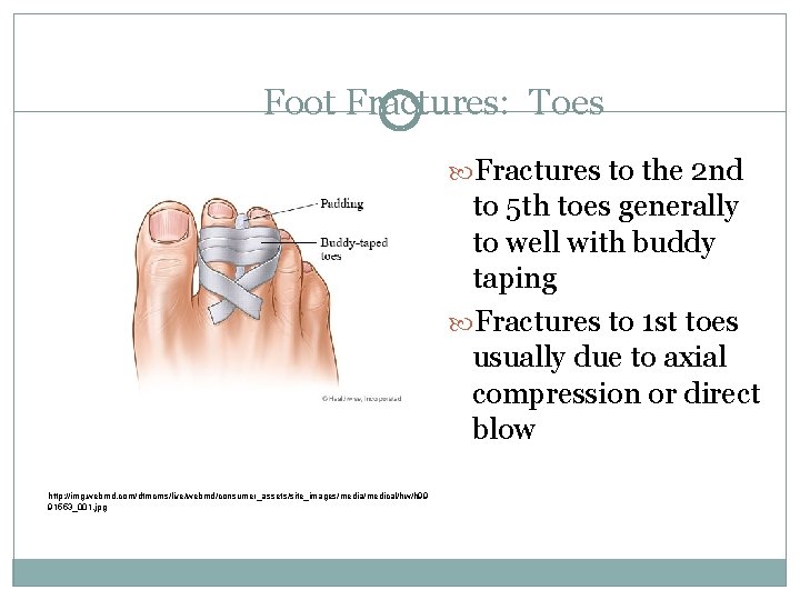 Foot Fractures: Toes Fractures to the 2 nd to 5 th toes generally to