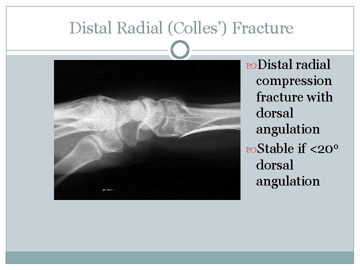 Distal Radial (Colles’) Fracture Distal radial compression fracture with dorsal angulation Stable if <20
