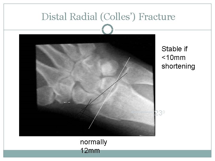 Distal Radial (Colles’) Fracture Stable if <10 mm shortening 23 o normally 12 mm