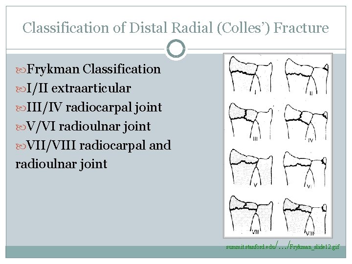 Classification of Distal Radial (Colles’) Fracture Frykman Classification I/II extraarticular III/IV radiocarpal joint V/VI