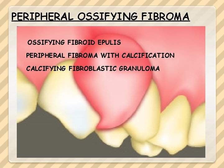 PERIPHERAL OSSIFYING FIBROMA OSSIFYING FIBROID EPULIS PERIPHERAL FIBROMA WITH CALCIFICATION CALCIFYING FIBROBLASTIC GRANULOMA 