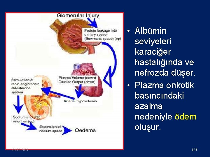  • Albümin seviyeleri karaciğer hastalığında ve nefrozda düşer. • Plazma onkotik basıncındaki azalma