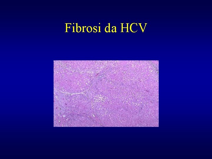 Fibrosi da HCV 