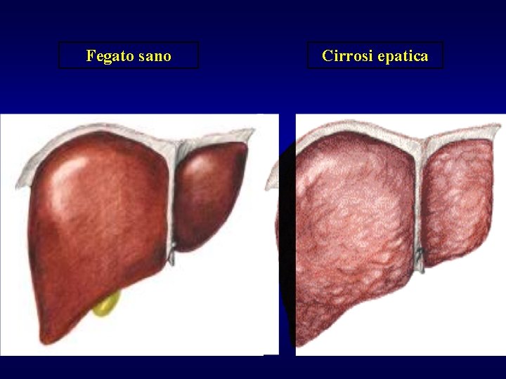 Fegato sano Cirrosi epatica 